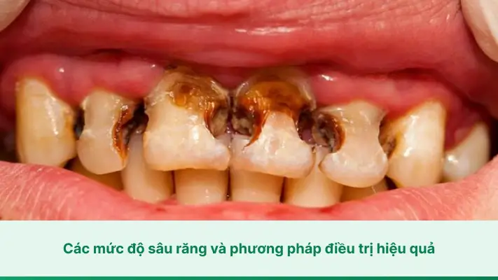 Các mức độ sâu răng và phương pháp điều trị hiệu quả