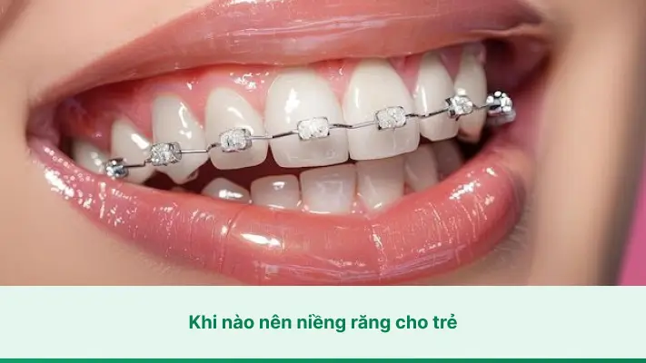 Khi nào nên niềng răng cho trẻ