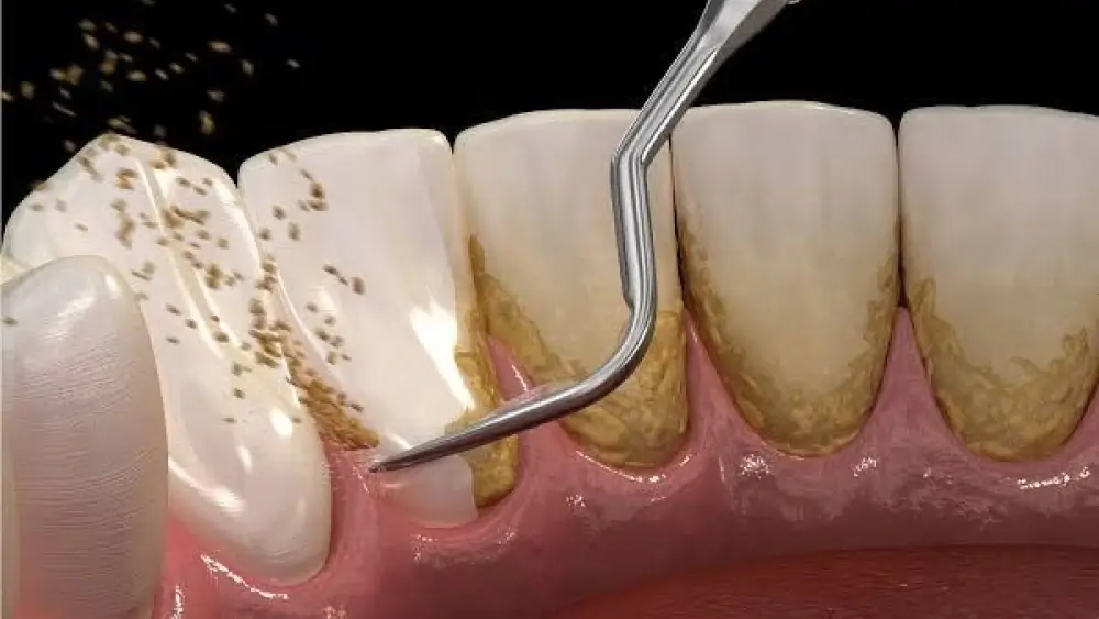 Cạo vôi răng